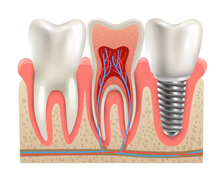Dental Implants Cost US