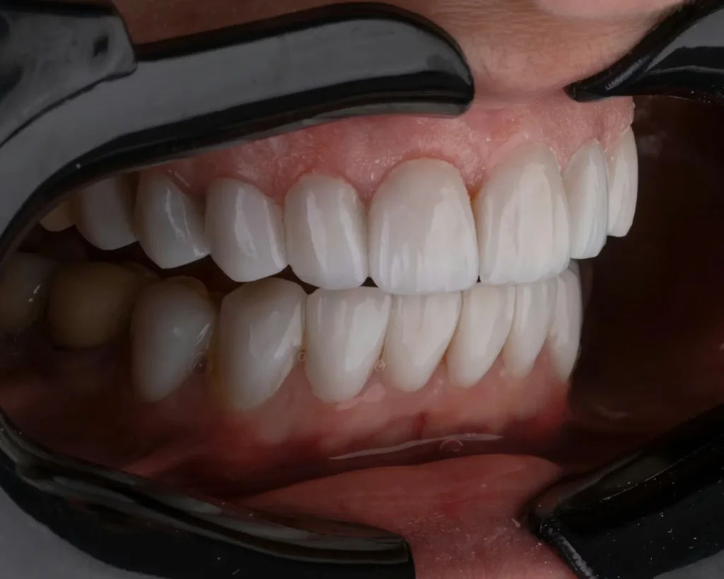 Full Set Dental Implants Cost in USA