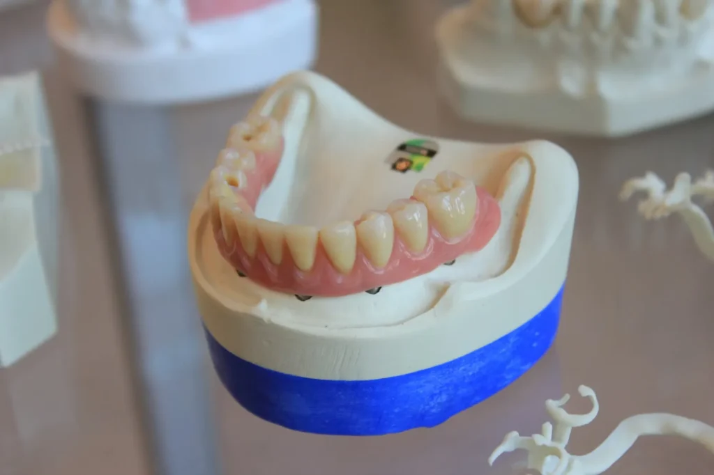 How Much Would a Full Set of Dental Implants Cost in the USA?